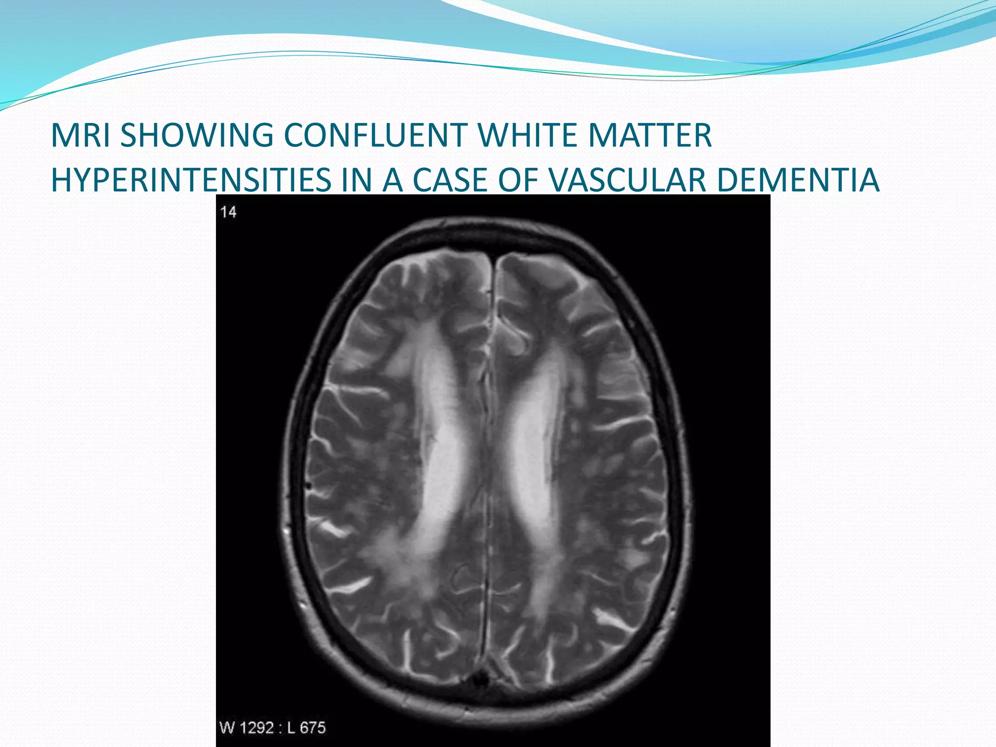 MRI SHOWING CONFLUENT WHITE MATTER 
HYPERINTENSITIES IN A CASE OF VASCULAR DEMENTIA 
 
