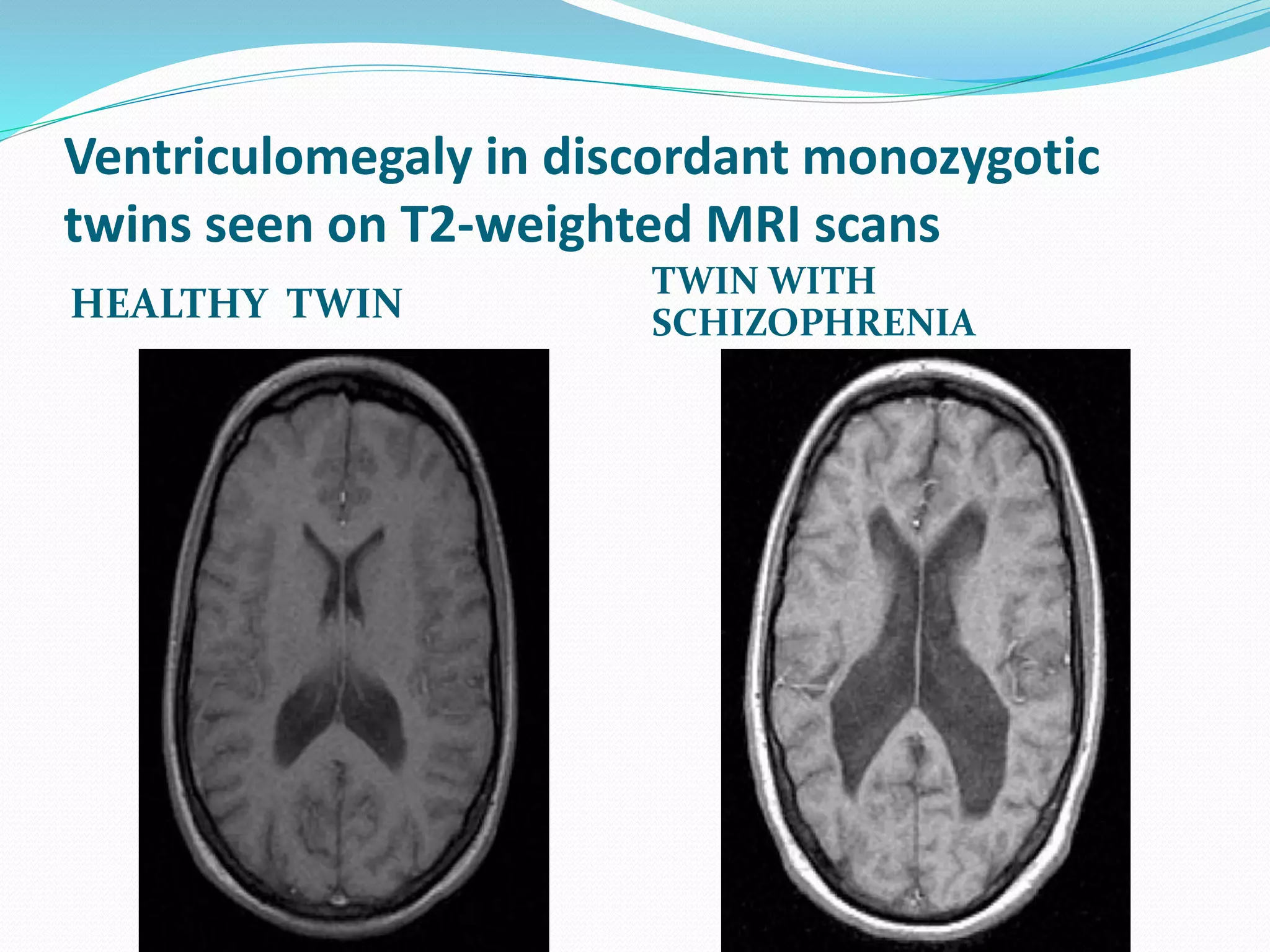 Ventriculomegaly in discordant monozygotic 
twins seen on T2-weighted MRI scans 
HEALTHY TWIN 
TWIN WITH 
SCHIZOPHRENIA 
 