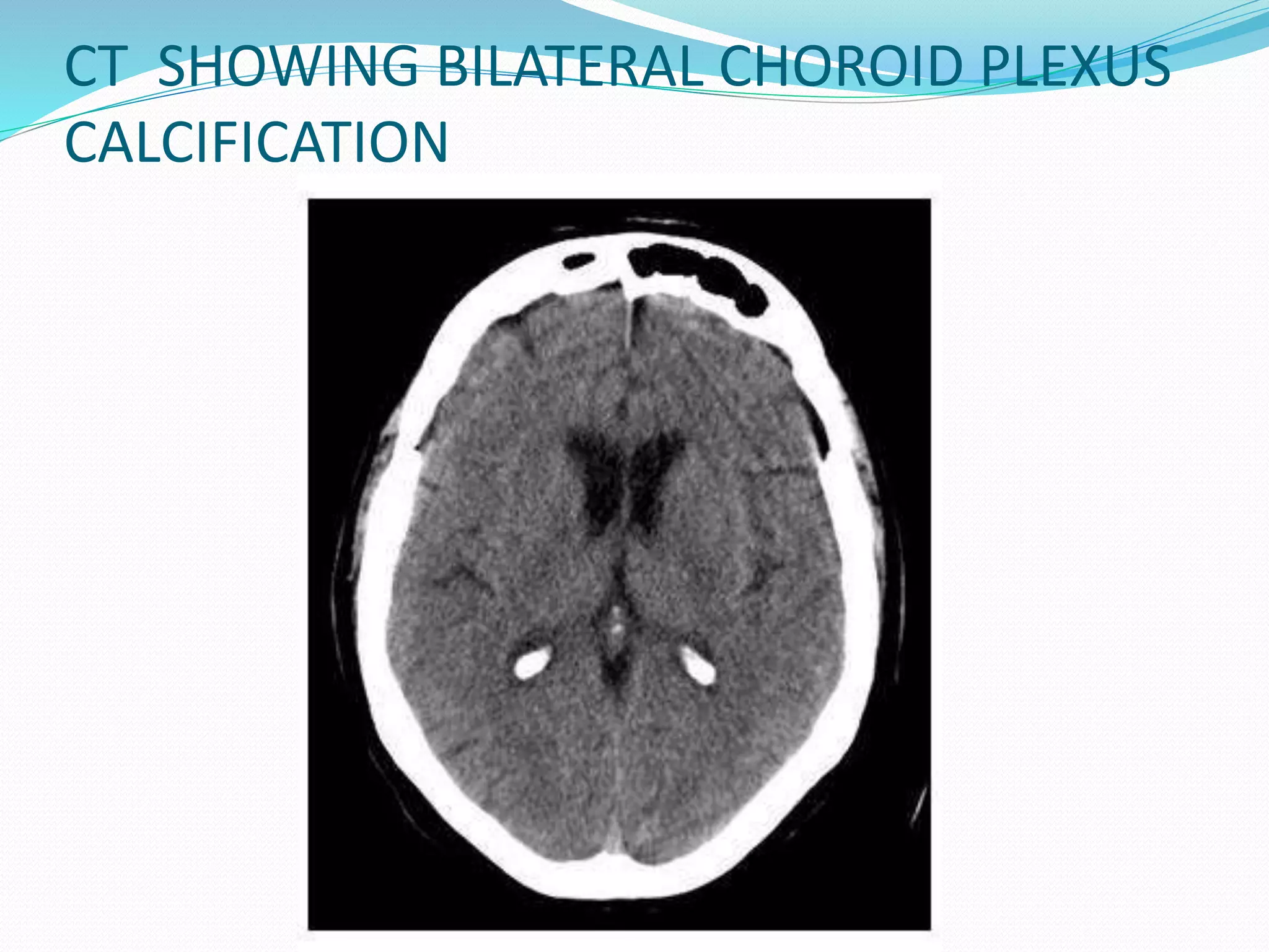 CT SHOWING BILATERAL CHOROID PLEXUS 
CALCIFICATION 
 