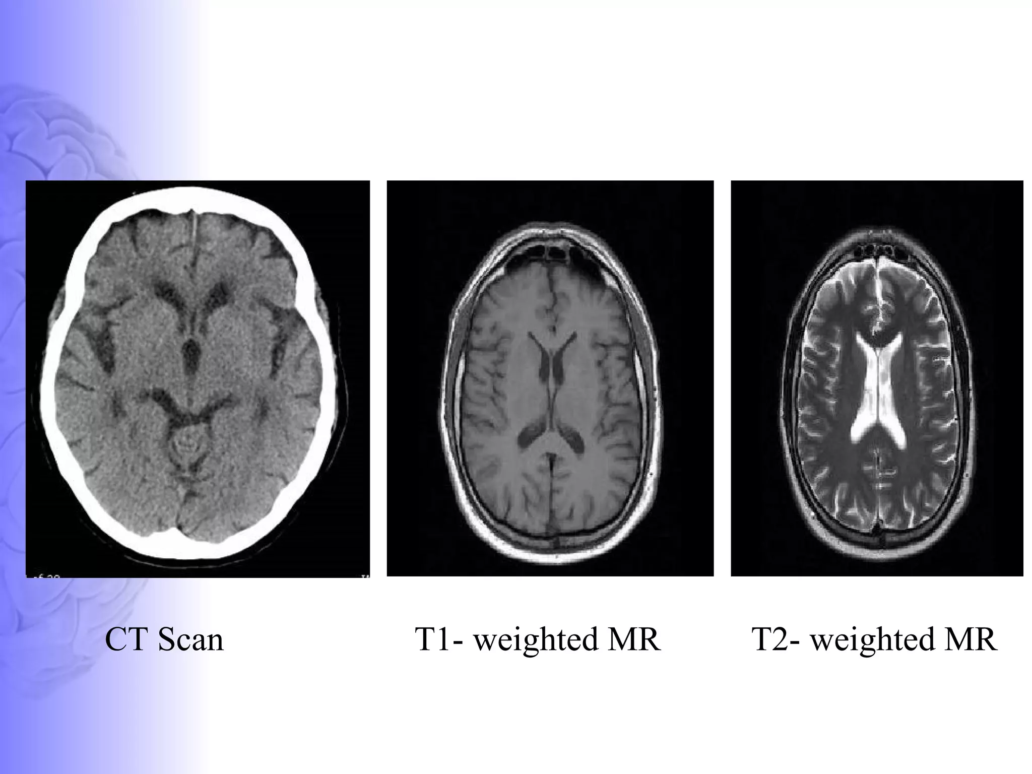T1- weighted MR  T2- weighted MR  CT Scan 