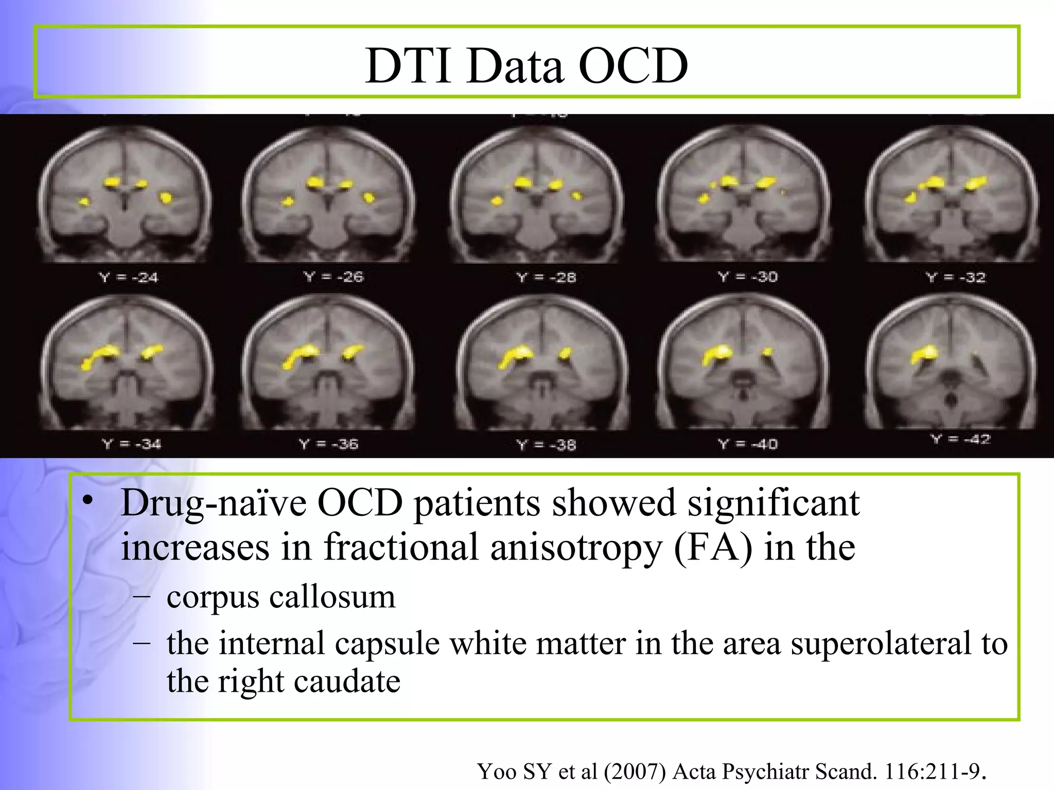 DTI Data OCD Drug-naïve OCD patients showed significant increases in fractional anisotropy (FA) in the  corpus callosum  the internal capsule white matter in the area superolateral to the right caudate  Yoo SY et al (2007) Acta Psychiatr Scand. 116:211-9 .  