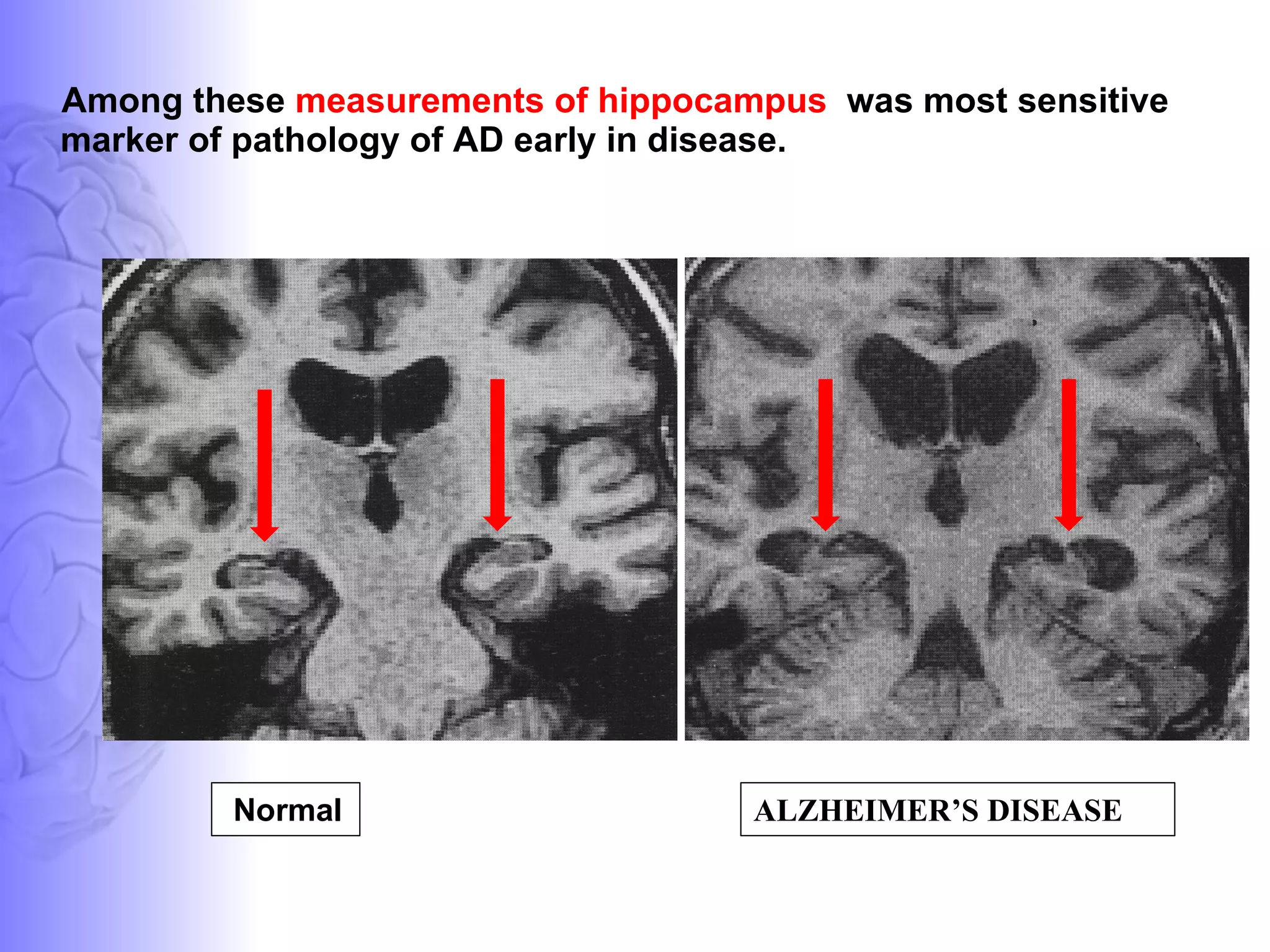 Among these  measurements of hippocampus  was most sensitive marker of pathology of AD early in disease.  Normal ALZHEIMER’S DISEASE  
