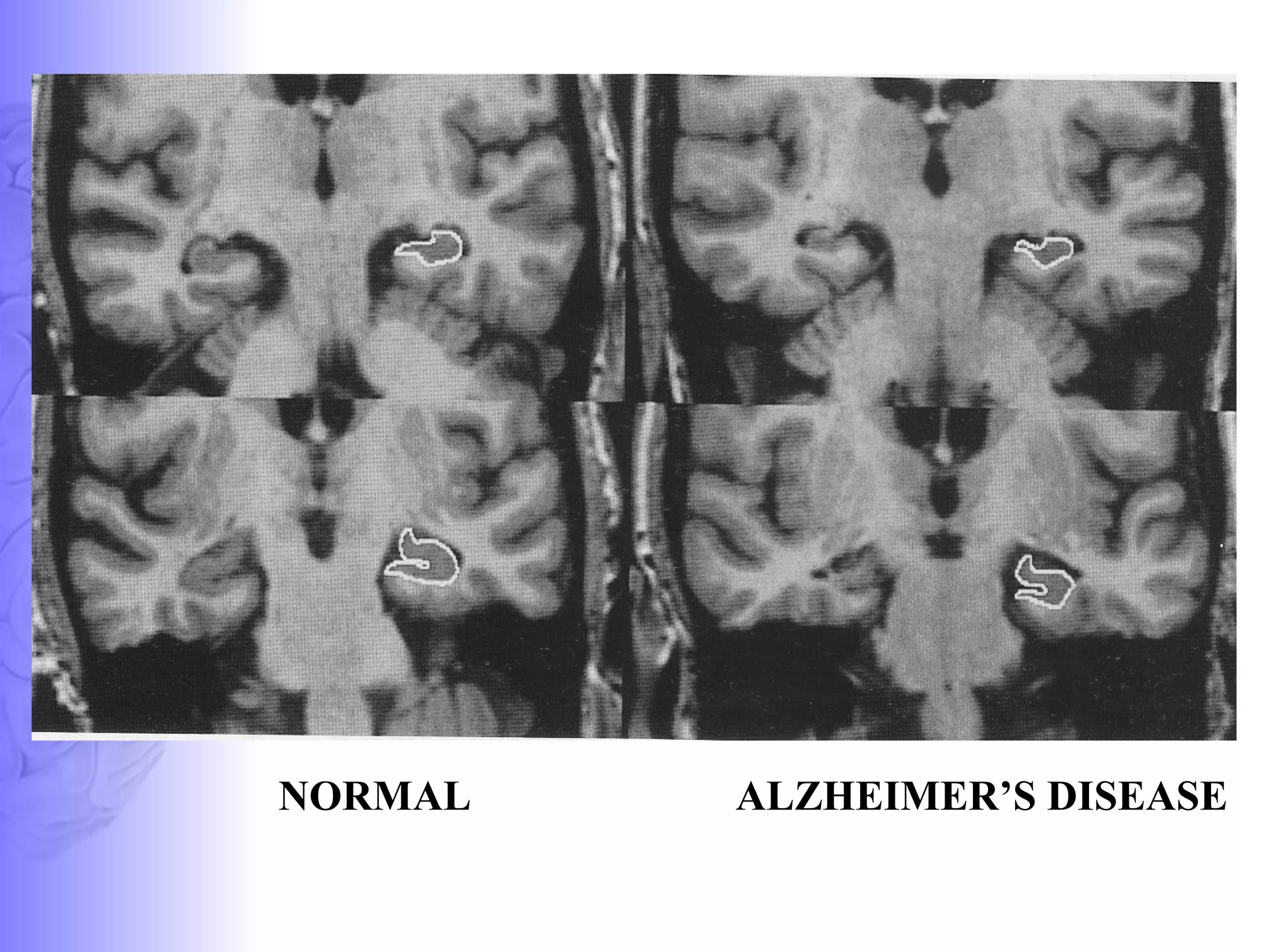 ALZHEIMER’S DISEASE  NORMAL 