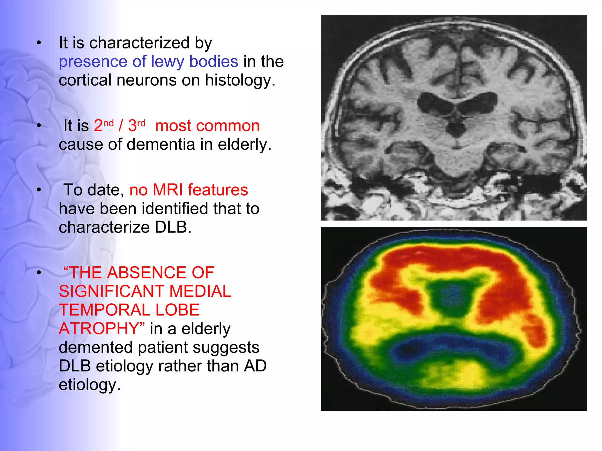 It is characterized by  presence of lewy bodies  in the cortical neurons on histology.  It is  2 nd  / 3 rd   most common  cause of dementia in elderly. To date,  no MRI features  have been identified that to characterize DLB.  “ THE ABSENCE OF SIGNIFICANT MEDIAL TEMPORAL LOBE ATROPHY”  in a elderly demented patient suggests DLB etiology rather than AD etiology. 