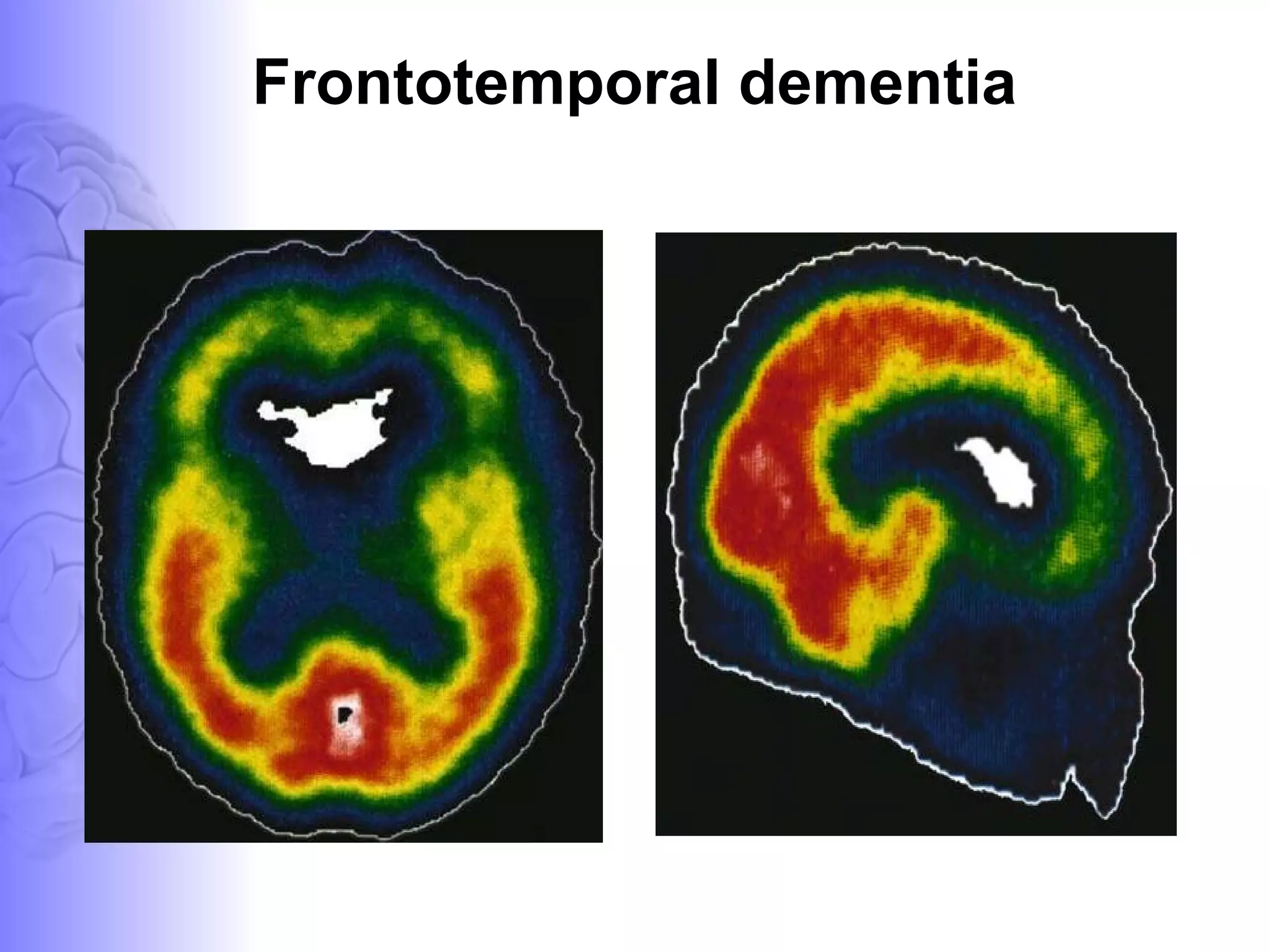 Frontotemporal dementia 