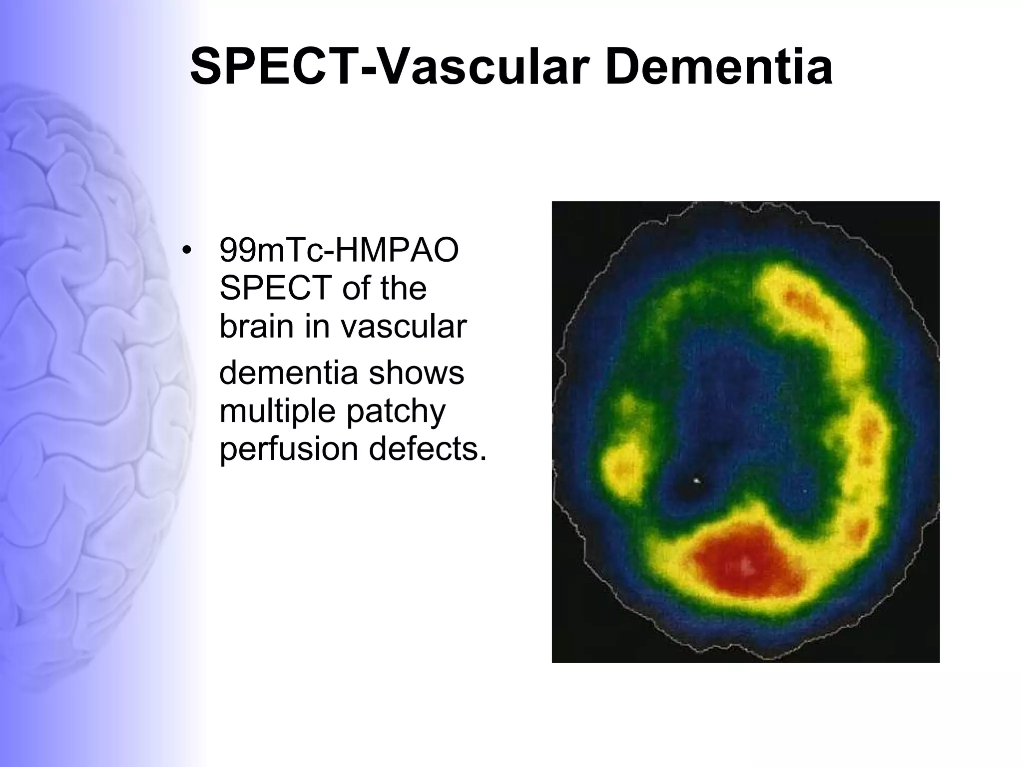 SPECT-Vascular Dementia 99mTc-HMPAO SPECT of the brain in vascular dementia shows multiple patchy perfusion defects. 