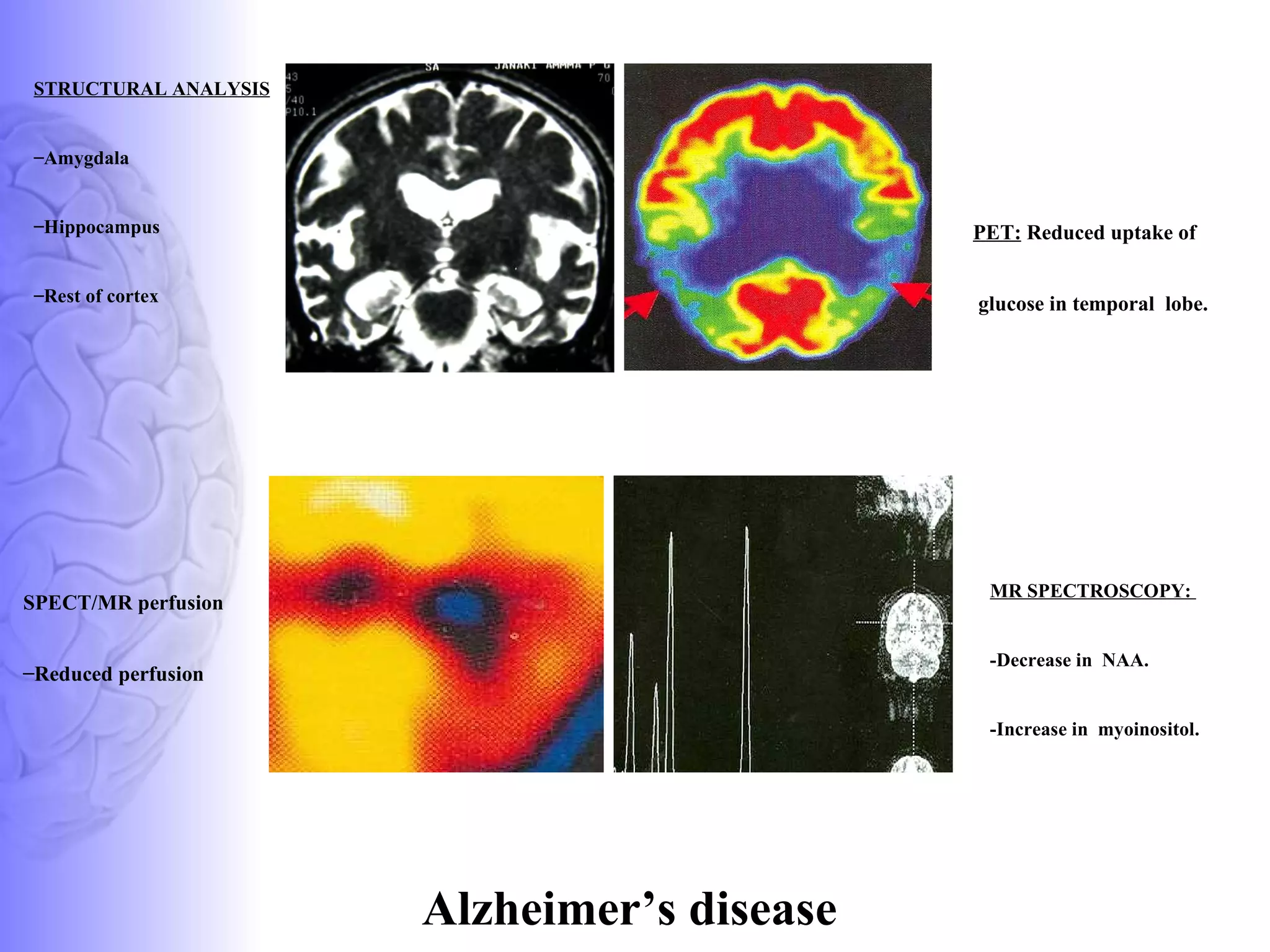 STRUCTURAL ANALYSIS Amygdala Hippocampus Rest of cortex PET:  Reduced uptake of  glucose in temporal  lobe.  SPECT/MR perfusion Reduced perfusion MR SPECTROSCOPY:  -Decrease in  NAA. -Increase in  myoinositol.   Alzheimer’s disease 