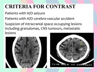 CRITERIA FOR CONTRAST
Patients with H/O seizure
Patients with H/O cerebro-vascular accident
Suspicion of intracranial space occupying lesions
including granulomas, CNS tumours, metastatic
lesions
 