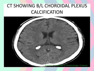 CT SHOWING B/L CHOROIDAL PLEXUS
CALCIFICATION
 