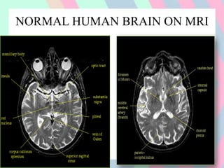 NORMAL HUMAN BRAIN ON MRI
 