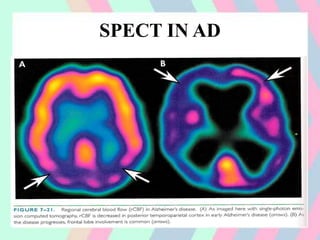 SPECT IN AD
 