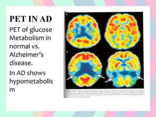 PET IN AD
PET of glucose
Metabolism in
normal vs.
Alzheimer’s
disease.
In AD shows
hypometabolis
m
 