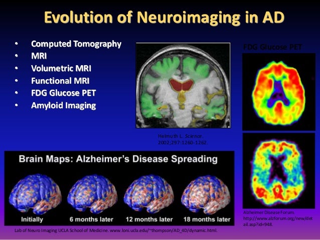 Neuroimaging Of Alzheimers