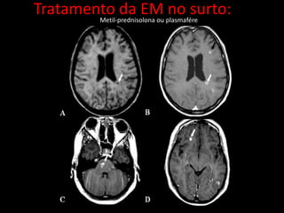 Tratamento da EM no surto:Metil-prednisolona ou plasmafére