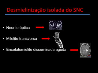 Desmielinização isolada do SNCNeurite óptica