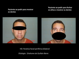 Síndrome de Guillain Barré Precedida por doença infecciosa  2/3 casos ( 2 e 28 dias do primeiro sintoma neurológico)Infecção do trato respiratório: 30 a 45% dos casos - Cytomegalovirus, vírus de Epstein-Barr e Mycoplasma pneumoniae e Haemophilus influenzae.