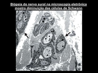 IMUNOPATOGÊNESE DO CIDPNEJM 2005
