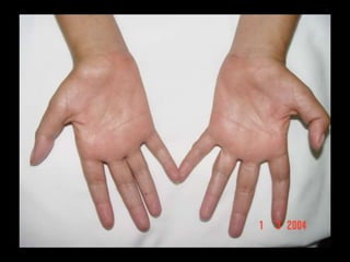 Biópsia do nervo suralMorfologia normal com focal infiltrado linfocítico (hematoxilina e eosina)