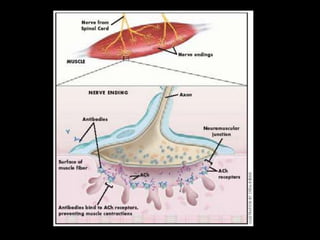 TratamentoAs alternativas terapêuticas, cujas eficácias foram comprovadas através de estudos prospectivos, controlados e randomizados, incluem corticosteróides e imunoglobulina humana endovenosa em altas doses, eventualmente plasmaférese . Ciclofosfamida e ciclosporina poderiam ser eficazes. IgIV é superior a corticosteróides mas, levando em consideração o alto custo, esses são considerados de primeira escolha .