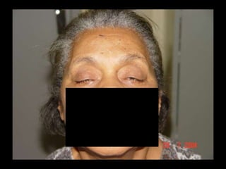 Miastenia GravesDoença auto-imune que tem como alvo os receptores nicotínicos de acetilcolina na membrana pós-sináptica da junção neuromuscularA prevalência é de 2,5 a 10/100.000 hab Tratamento a longo prazo são os imunossupressores e a timectomia