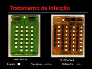 infiltraçãoNóduloplacaMancha