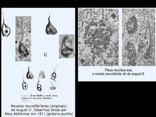 Paciente da Santa Casa do Rio de Janeiro com neuropatia da HanseníaseMal perfurante plantar