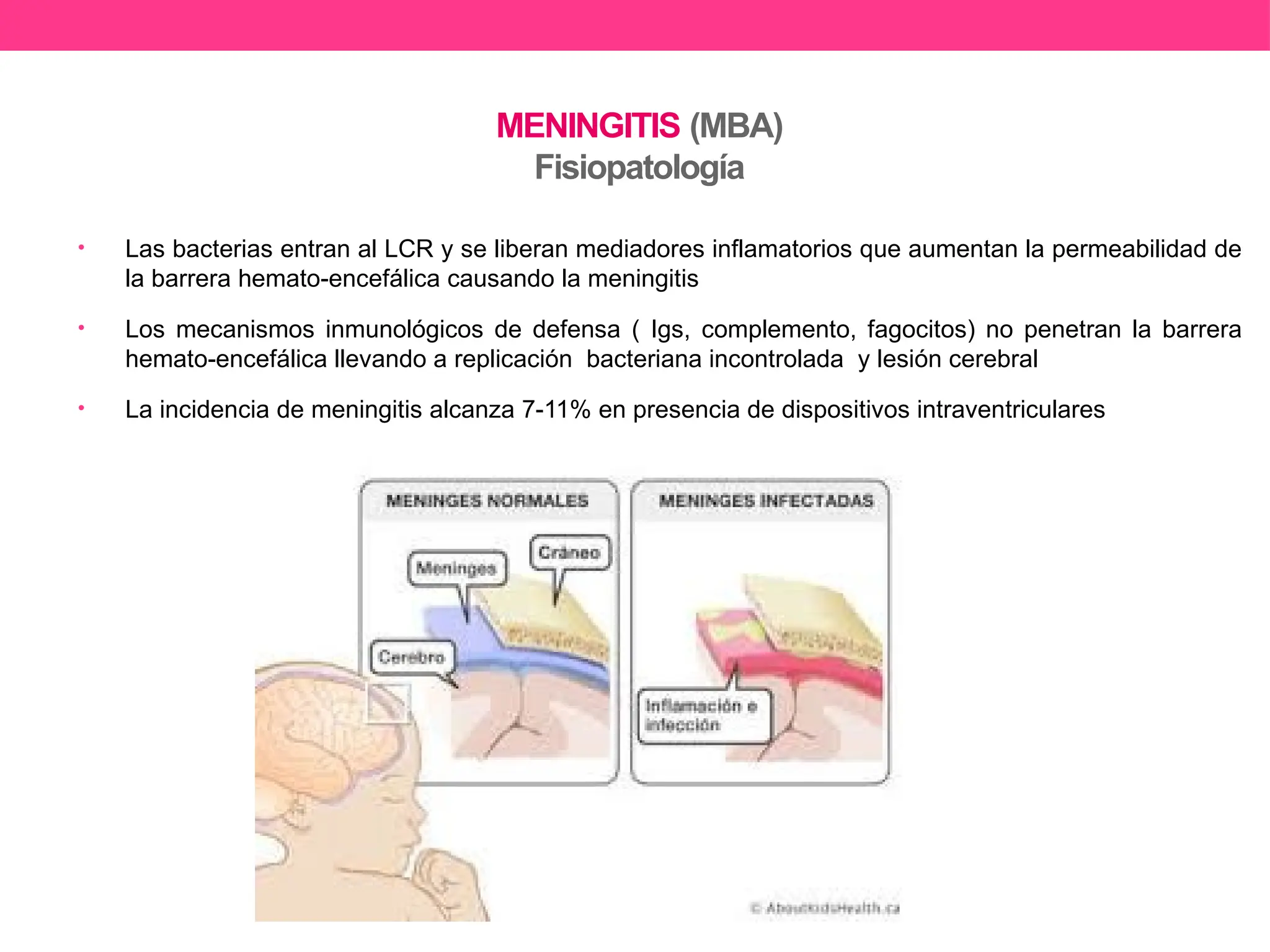 Neuroinfeccioines. MBA, ENCEFALITIS Y MIELOMENINGOCELE Skarleh.pptx