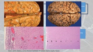 Anatomía patológica
Opacidades pardo-amarillentos que borran los surcos
y corresponden al exudado inflamatorio
Infiltrado de neutrófilos, vasos dilatados, edema
cerebral
Klatt, E. (2007). Robbins y Cotran ATLAS DE ANATOMIA PATOLOGICA. Madrid, España: Elsevier.
 