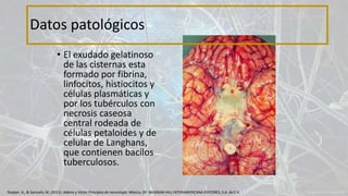 • El exudado gelatinoso
de las cisternas esta
formado por fibrina,
linfocitos, histiocitos y
células plasmáticas y
por los tubérculos con
necrosis caseosa
central rodeada de
células petaloides y de
celular de Langhans,
que contienen bacilos
tuberculosos.
Datos patológicos
Ropper, A., & Samuels, M. (2011). Adams y Victor Principios de neurología. México, DF: McGRAW-HILL INTERAMERICANA EDITORES, S.A. de C.V.
 