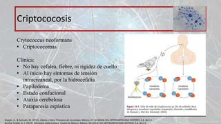 Criptococosis
Crytococcus neoformans
• Criptococomas
Clínica:
• No hay cefalea, fiebre, ni rigidez de cuello
• Al inicio hay síntomas de tensión
intracreaneal, por la hidrocefalia
• Papiledema
• Estado confucional
• Ataxia cerebelosa
• Paraparesia espástica
Ropper, A., & Samuels, M. (2011). Adams y Victor Principios de neurología. México, DF: McGRAW-HILL INTERAMERICANA EDITORES, S.A. de C.V.
Bonifaz Trujillo, A. J. (2012). Micología médica básica. Ciudad de México, México: McGRAW-HILL INTERAMERICANA EDITORES, S.A. de C.V.
 