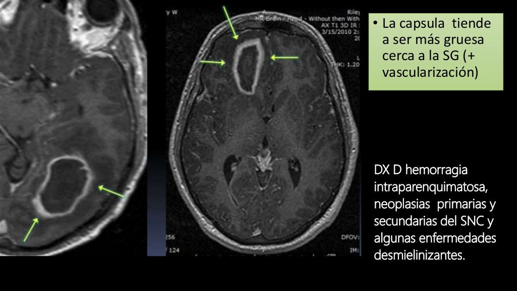 Neuroinfecciones proyectados en imagen