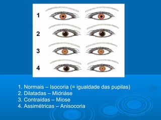 1. Normais – Isocoria (= igualdade das pupilas)
2. Dilatadas – Midriáse
3. Contraídas – Miose
4. Assimétricas – Anisocoria
 