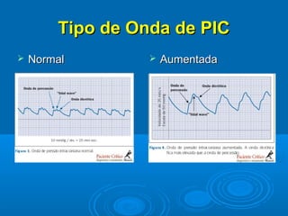 Tipo de Onda de PIC
   Normal           Aumentada
 