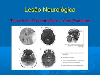 Lesão Neurológica
Tipos de Lesão Neurológica – Área Penumbra
 