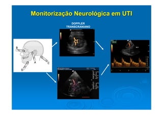 Monitorização Neurológica em UTI
              DOPPLER
           TRANSCRANIANO
 
