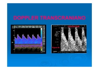 DOPPLER TRANSCRANIANO
 