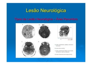 Lesão Neurológica
Tipos de Lesão Neurológica – Área Penumbra
 