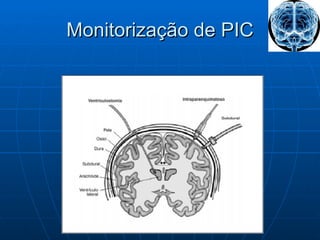 Monitorização de PIC 
