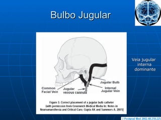 Bulbo Jugular Veia jugular  interna dominante 