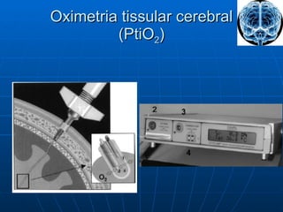 Oximetria tissular cerebral (PtiO 2 ) 