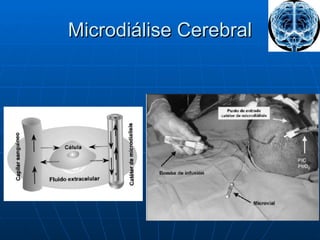 Microdiálise Cerebral 