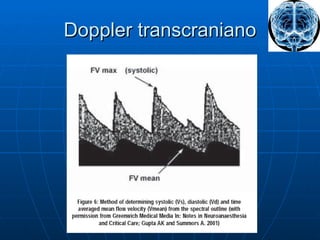 Doppler transcraniano 