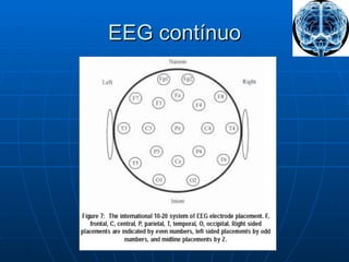 EEG contínuo 