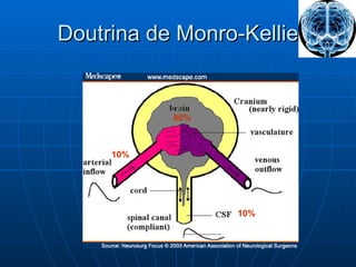 Doutrina de Monro-Kellie 10% 10% 80% 