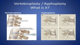 Neuro interventional procedures