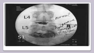 Neuro interventional procedures