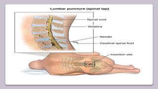 Neuro interventional procedures