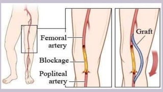 Neuro interventional procedures