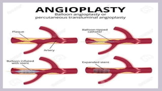 Neuro interventional procedures