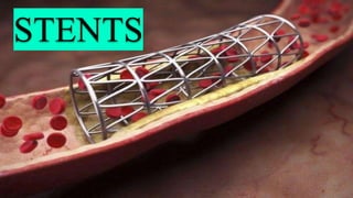 STENTS
 